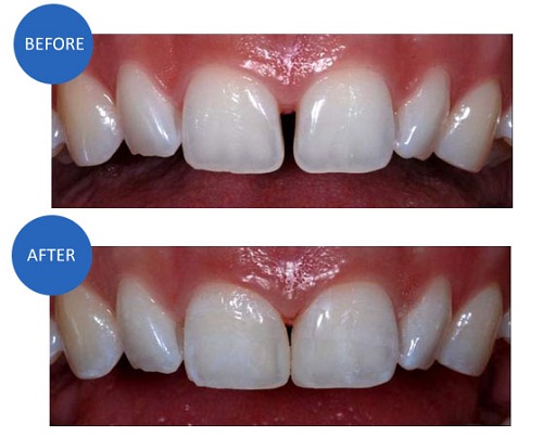 Cách điều trị răng thưa tại Nha Khoa Lê Hưng hiệu quả 100% 