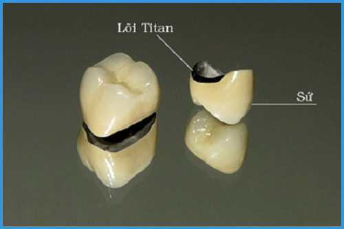 Giới thiệu cách trồng răng sứ titan tại Nha Khoa Lê Hưng 