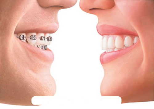 Niềng răng có tác dụng gì và nên thực hiện ở đâu tốt nhất?