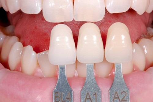 Nên niềng răng hay bọc sứ chỉnh hình nha khoa thẩm mỹ tốt hơn?