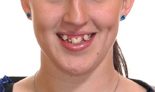 Niềng răng khểnh mất bao lâu để có một hàm răng đẹp?