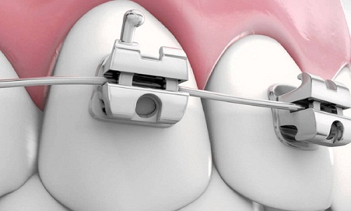 Niềng răng nhanh nhất mất thời gian bao lâu thì hiệu quả? 