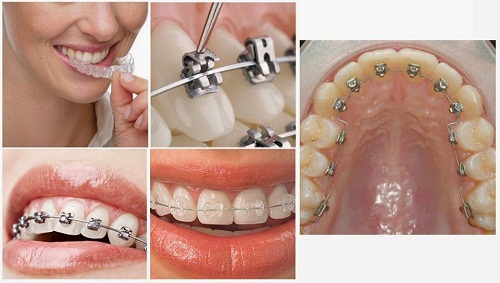 Niềng răng như thế nào vừa đẹp lại hiệu quả nhất? 