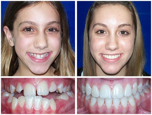 Niềng răng như thế nào vừa đẹp lại hiệu quả nhất? 
