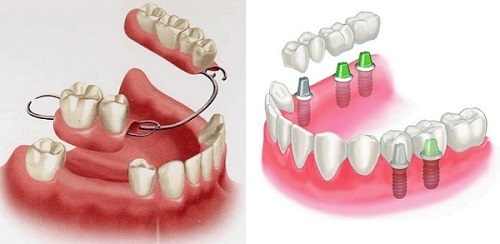 Tìm hiểu về phương pháp lắp hàm răng giả thẩm mỹ