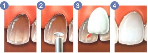 Quy trình đắp răng sứ tiêu chuẩn của Nha khoa Lê Hưng 