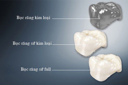 Răng sứ kim loại có tốt không và nên chọn loại nào? 