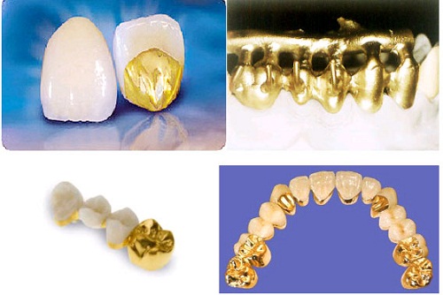 Răng sứ kim loại có tốt không và nên chọn loại nào? 
