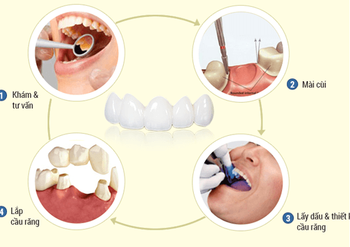 Bọc răng sứ chữa hô có giải quyết được hiệu quả không?