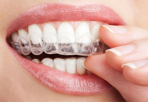 Chỉnh răng không cần niềng có hiệu quả hay không? 