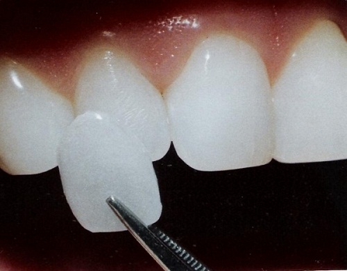 Đắp răng sứ là gì và được thực hiện như thế nào?