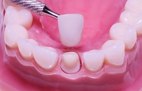 Những điều cần lưu ý khi đắp răng sứ để đảm bảo chất lượng