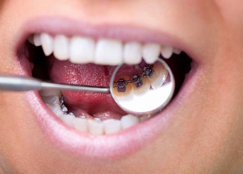 Niềng răng bên trong có những ưu nhược điểm gì?