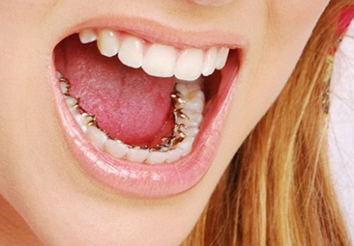 Niềng răng bên trong có những ưu nhược điểm gì?