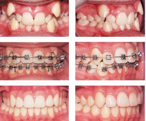 Cách xử lý răng không đều như thế nào hiệu quả?