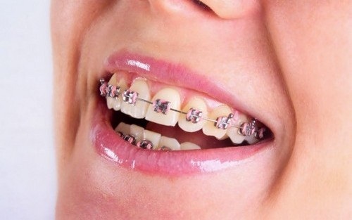 Tổng hợp ưu và nhược điểm của các phương pháp niềng răng 