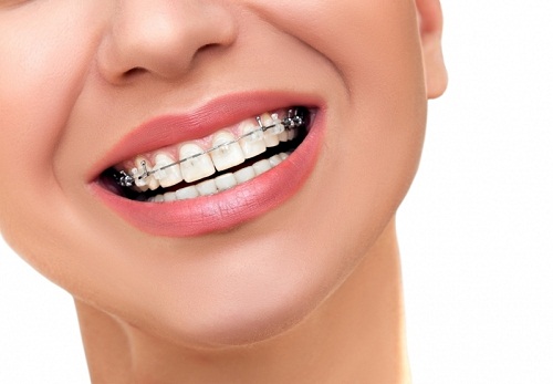 Tổng hợp ưu và nhược điểm của các phương pháp niềng răng