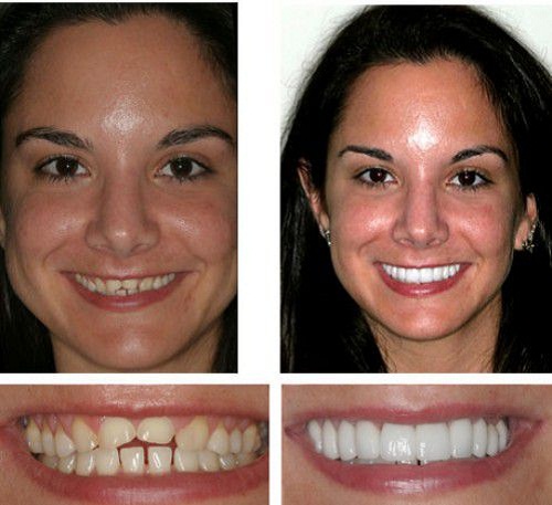Tư vấn nha khoa: Răng bị móm có nên đắp răng sứ không?