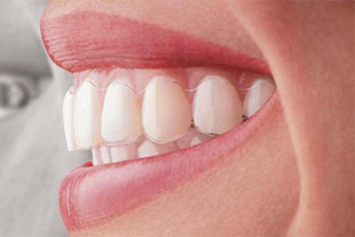 Gía niềng răng ivisalign bao nhiêu là chuẩn nhất tại Hà Nội?