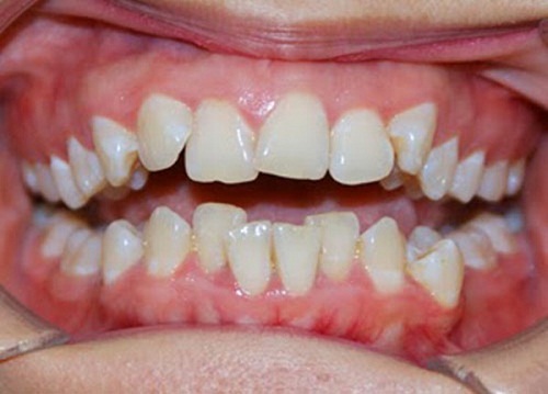 Gợi ý các cách nắn chỉnh răng khểnh cho đạt chuẩn theo tỷ lệ vàng 