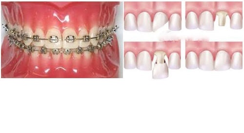 Gợi ý các cách nắn chỉnh răng khểnh cho đạt chuẩn theo tỷ lệ vàng 