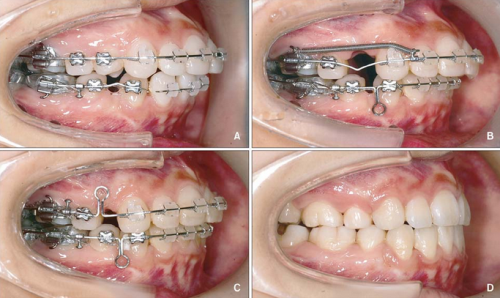 Sửa răng hô bằng phương pháp niềng răng chỉnh hình cần lưu ý gì?
