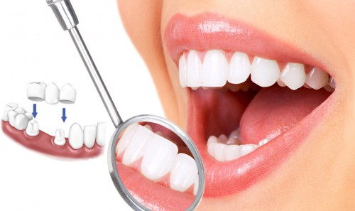 Khi răng mọc lệch nên niềng răng hay bọc sứ tốt hơn?