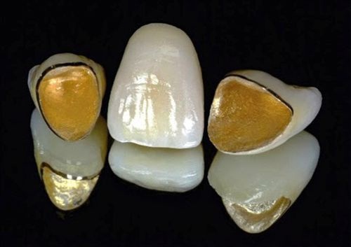 Bác sĩ Lê Hưng tư vấn: Có nên bọc răng sứ kim loại hay không? 