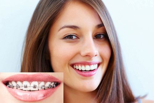 30 Tuổi có niềng răng được không và hiệu quả như thế nào?