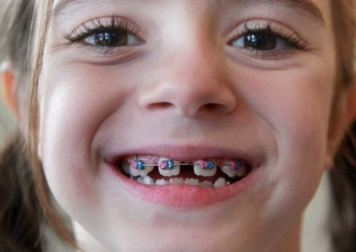 Trẻ em bao nhiêu tuổi thì được niềng răng chỉnh hình thẩm mỹ?