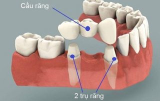 Làm cầu răng có tốt không và sử dụng được bao lâu?