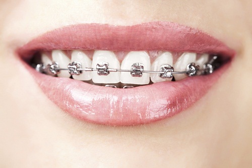 Nên niềng răng hay bọc sứ chỉnh hình nha khoa thẩm mỹ tốt hơn?
