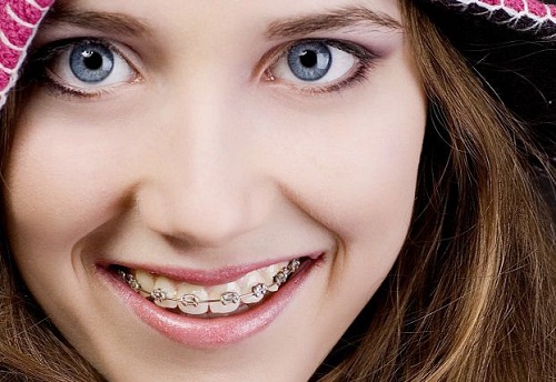Niềng răng nhanh nhất mất thời gian bao lâu thì hiệu quả?