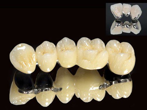 Răng sứ kim loại có tốt không và nên chọn loại nào?