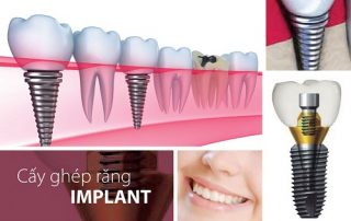 Cấy Implant ở đâu tốt đảm bảo chất lượng và giá thành phải chăng?