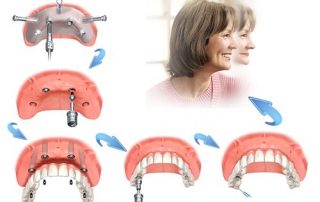 Cấy ghép Implant được sử dụng cho những trường hợp nào?