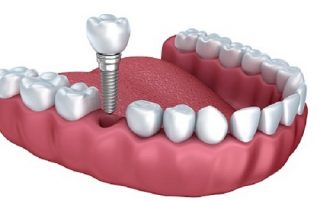 Cấy ghép răng Implant có đau không và thực hiện như thế nào?