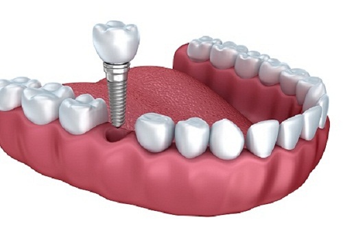Cấy ghép răng Implant có đau không và thực hiện như thế nào?