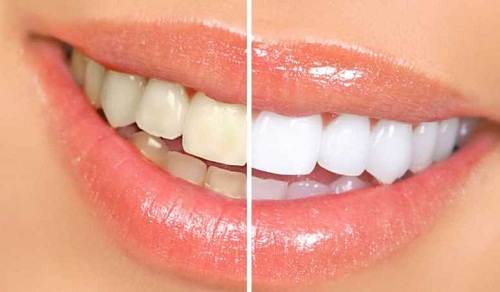 Đắp răng sứ là gì và được thực hiện như thế nào?