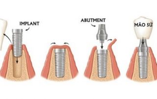 Ghép răng Implant và những lưu ý không thể bỏ qua