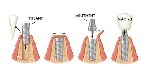 Ghép răng Implant và những lưu ý không thể bỏ qua