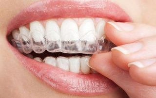 Giá niềng răng invisalign bao nhiêu tại Nha khoa Lê Hưng?