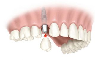 Tìm hiểu về kỹ thuật cấy ghép Implant trong nha khoa hiện đại