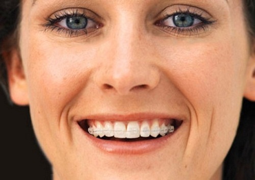 Những ưu điểm của niềng răng bằng sứ trong nha khoa thẩm mỹ