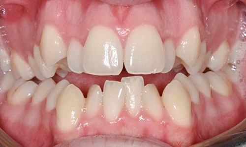 Cách xử lý răng không đều như thế nào hiệu quả?