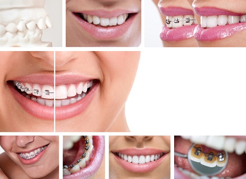 Bao nhiêu tuổi thì được niềng răng và các phương pháp thích hợp?