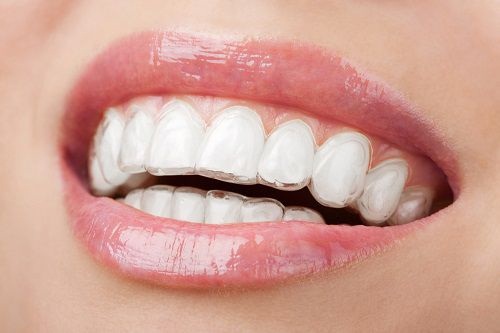 Những vấn đề cần lưu ý khi chỉnh răng không cần niềng?